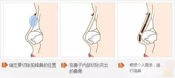 驼峰鼻矫正的缓解费用