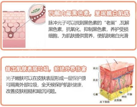 光子嫩肤的原理