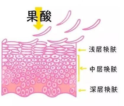 果酸换肤需要进行几次