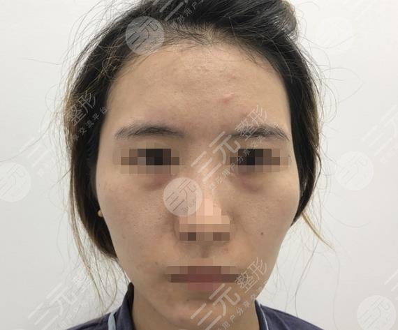 西安西京医院整形美容科面部脂肪填充过程