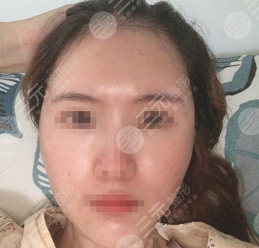 西安西京医院整形美容科面部脂肪填充过程