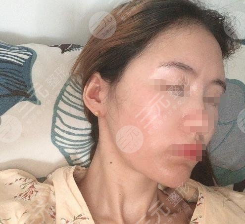 西安西京医院整形美容科面部脂肪填充过程