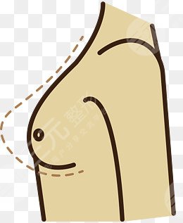 乳房悬吊图片前后对比图,术后一个月果反馈~