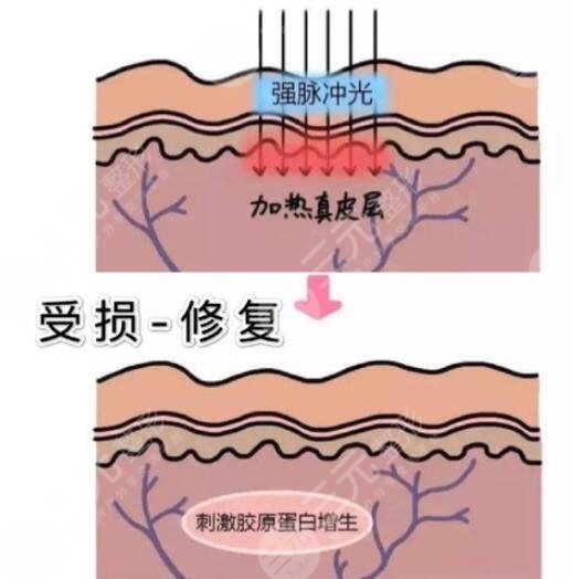 光子嫩肤的原理