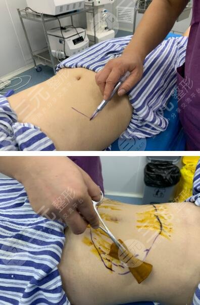 女人肚子抽脂手术图片图片