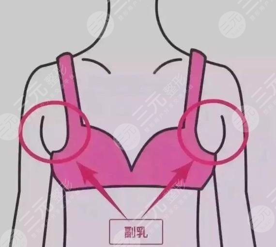 副乳吸脂