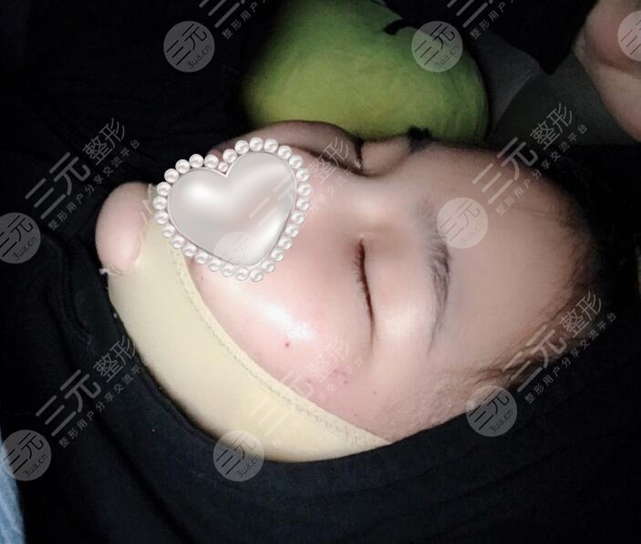 瘦脸面部吸脂术恢复过程图片