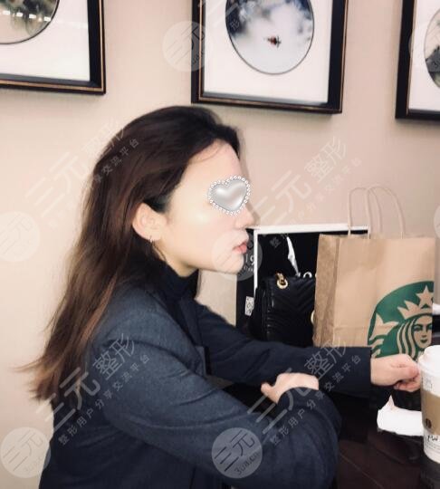 瘦脸面部吸脂术恢复过程图片