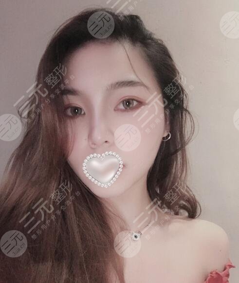 瘦脸面部吸脂术恢复过程图片