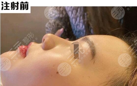 冯焕注射隆鼻前