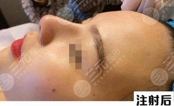 冯焕注射隆鼻后