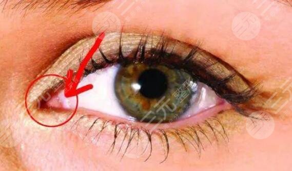 泪阜完全暴露的人不适合开眼角