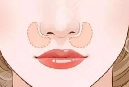 自体脂肪填充鼻唇沟多久吸收?注射填充的注意事项你都了解了么?