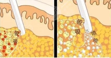 全身吸脂减肥的原理