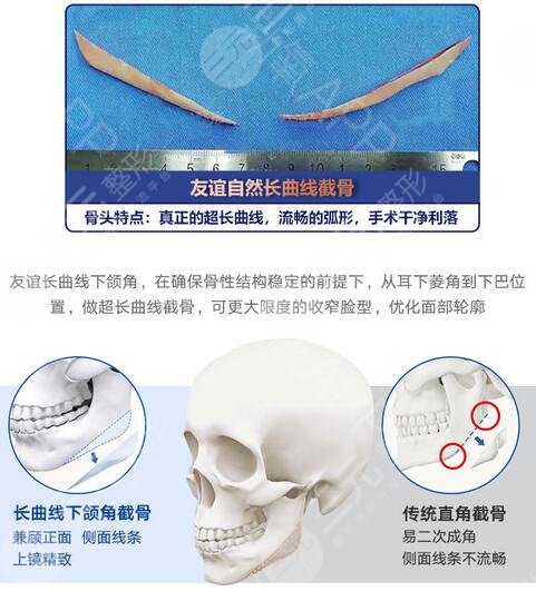 颧骨手术多少钱