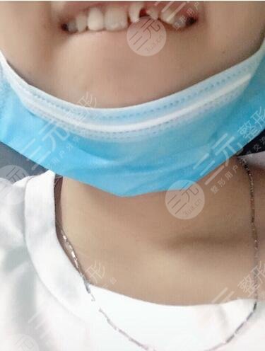 纯钛烤瓷牙案例