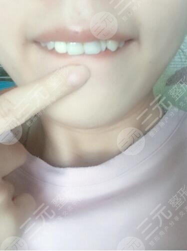 纯钛烤瓷牙案例