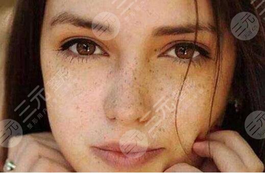 激光祛黄褐斑果如何