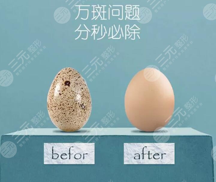 激光祛黄褐斑的价格