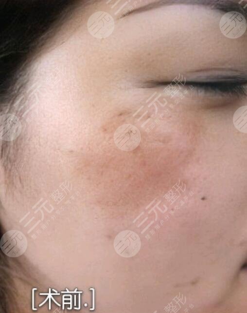 黄褐斑缓解前