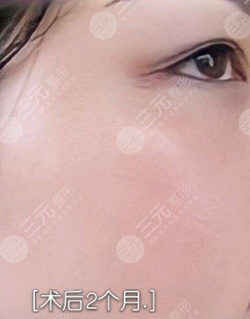 黄褐斑缓解后