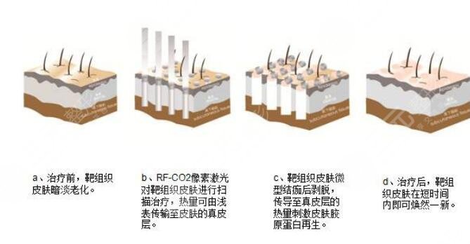 什么是像素激光美容