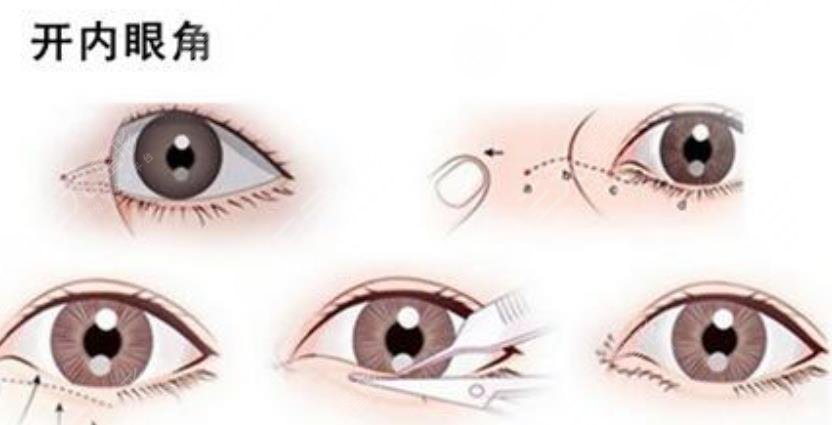 开眼角留疤可能性大吗?开眼角的注意事项本文都告诉你,术前了解