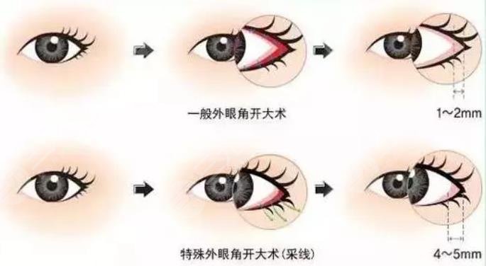 什么是开外眼角