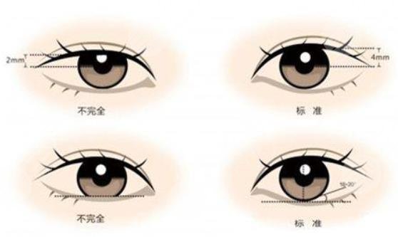 做双眼皮手术疼吗？手术的注意事项有哪些？你需要注意这些...
