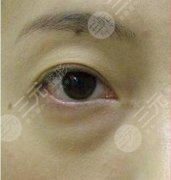 去眼袋手术后遗症明X吗？去眼袋手术价格分析|注意事项