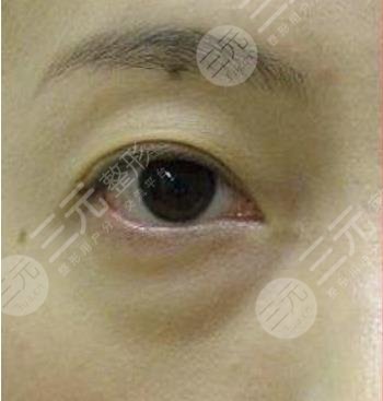 去眼袋手术后遗症明X吗？去眼袋手术价格分析|注意事项
