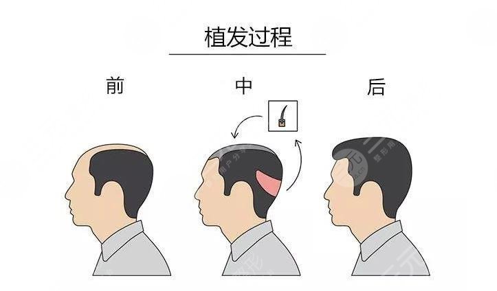 植发贵吗一般多少钱