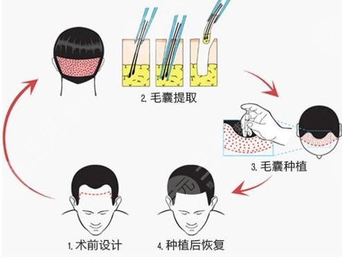 影响植发价格的因素