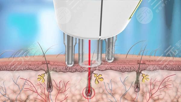 男士长时间脱毛方法