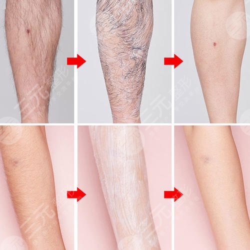 男士长时间脱毛方法