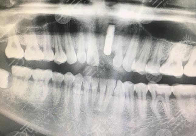 绍兴京韩口腔医院牙齿种植经历分享