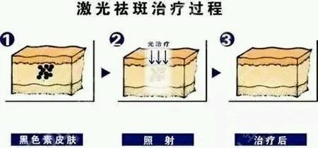 激光祛斑