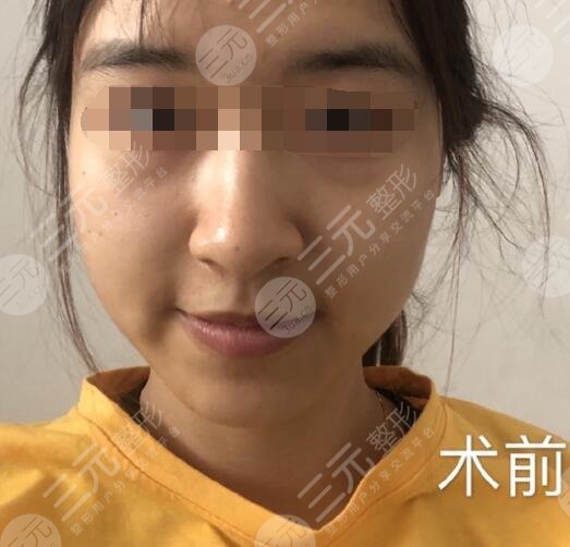 复合彩光嫩肤前