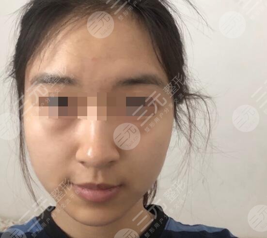 复合彩光嫩肤后