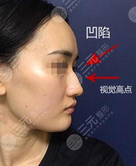 驼峰鼻手术一般多少钱比较合适