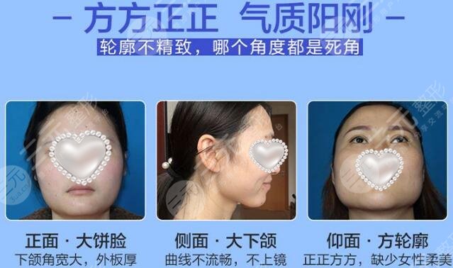 瓜子脸手术科普！优缺点&注意事项分享，必备攻略~