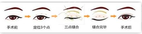 什么是定点双眼皮