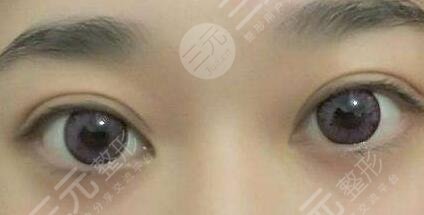 韩式or欧式双眼皮合适更好