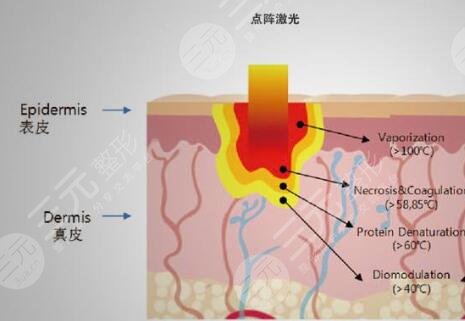 什么是光子嫩肤