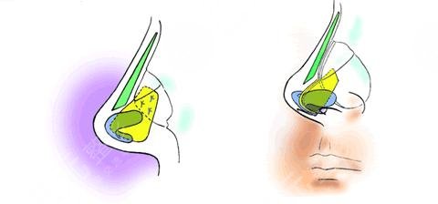自体软骨隆鼻术多少钱