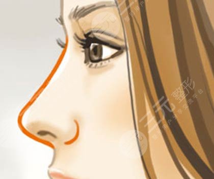 自体软骨隆鼻术多少钱