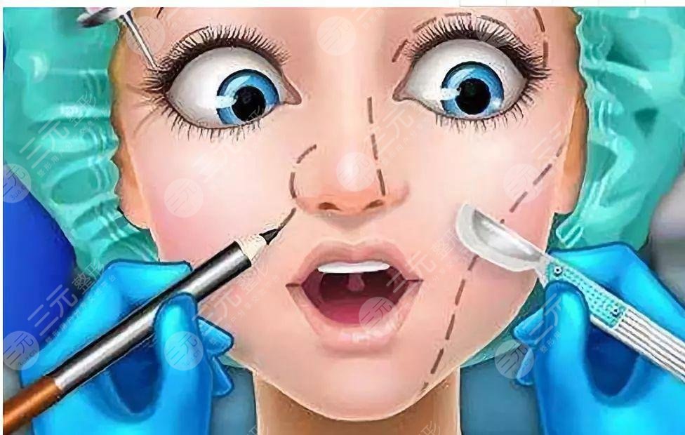 自体软骨隆鼻术多少钱