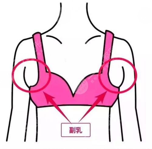 副乳切除手术几天恢复