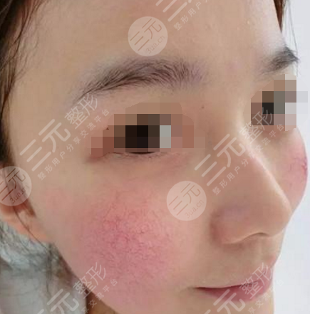 激光去红血丝的危害