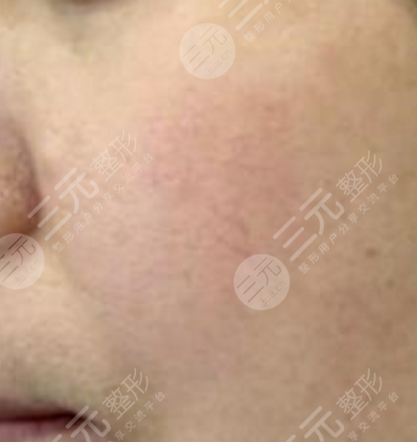 去脸部红血丝术后护理注意事项有哪些